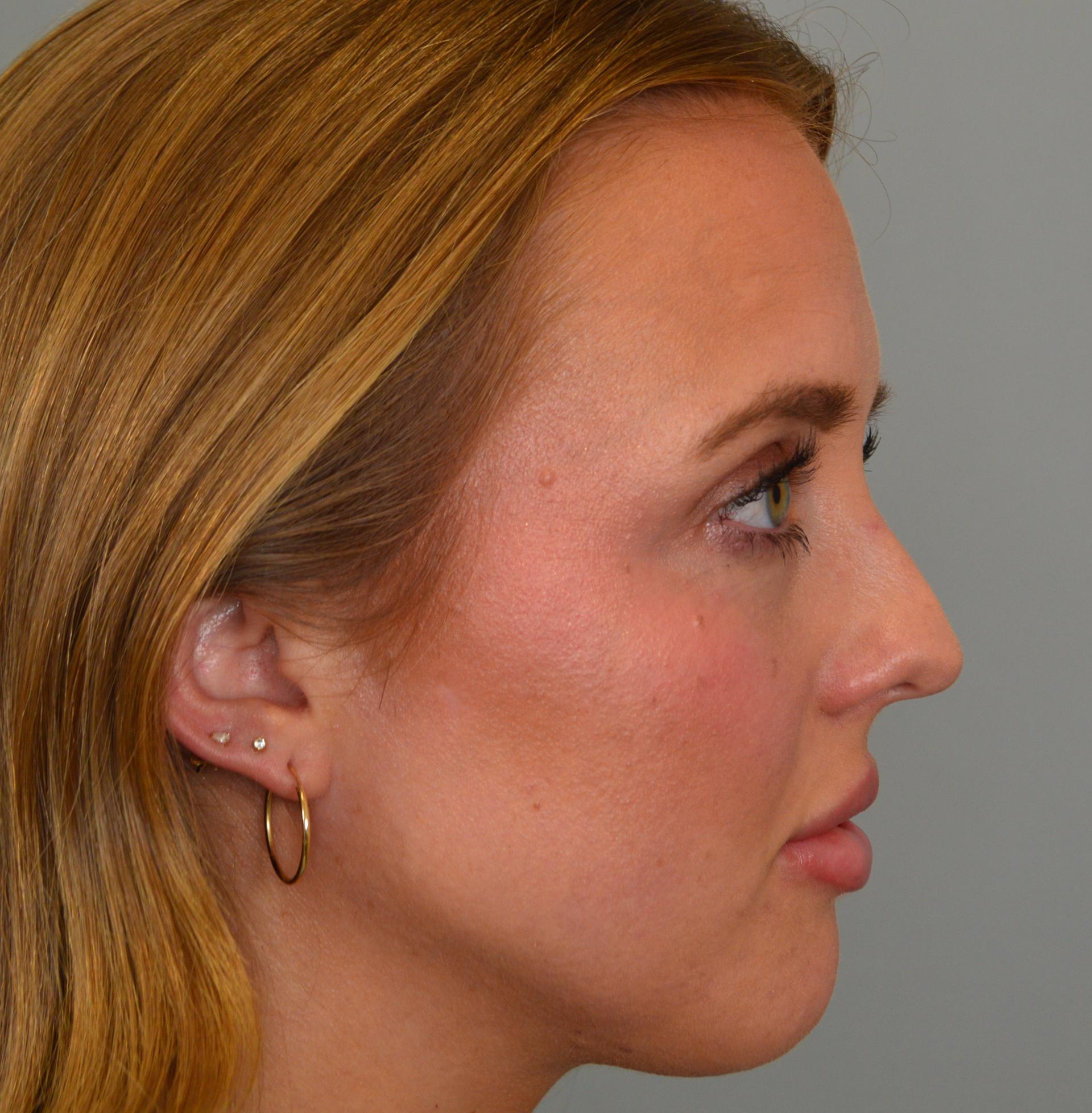 Jordan L. Wallin, MD rhinoplasty after — St. George, UT