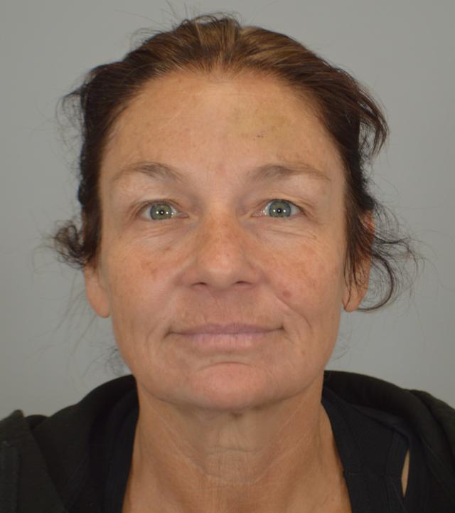 Facelift before at Jordan L. Wallin, MD in St. George, UT