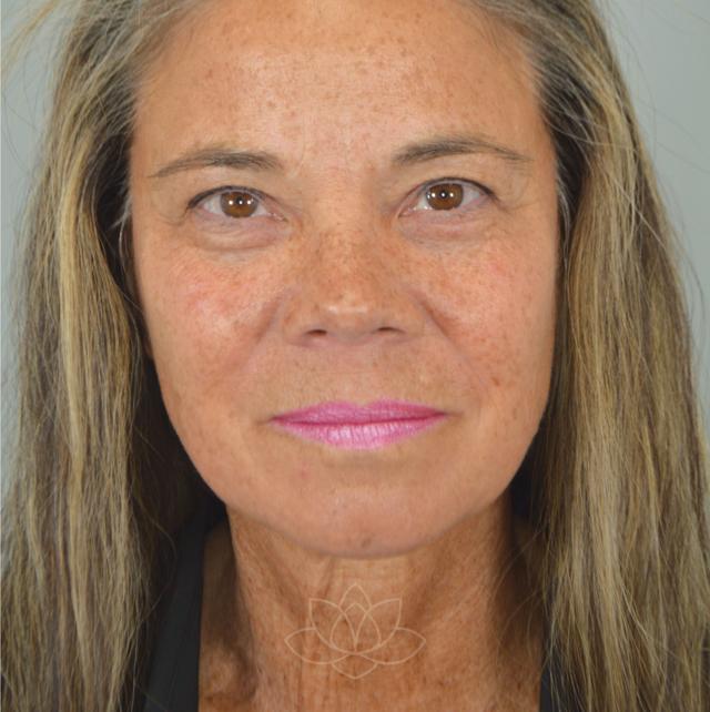 Facelift before at Jordan L. Wallin, MD in St. George, UT