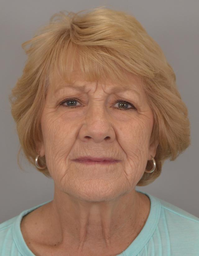 Facelift before at Jordan L. Wallin, MD in St. George, UT