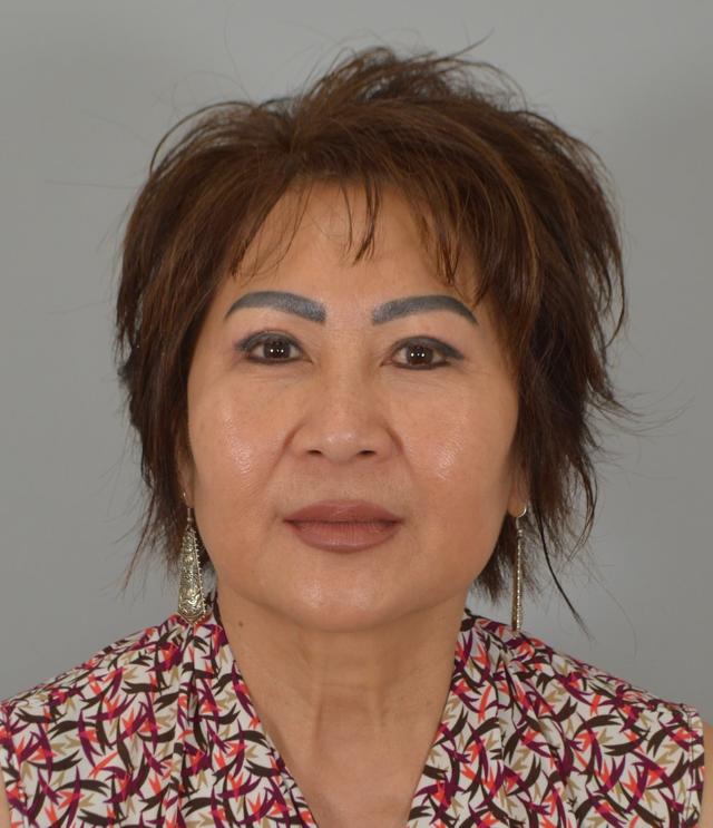 Blepharoplasty after at Jordan L. Wallin, MD in St. George, UT