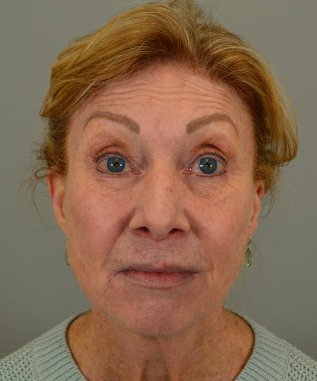 Facelift before at Jordan L. Wallin, MD in St. George, UT