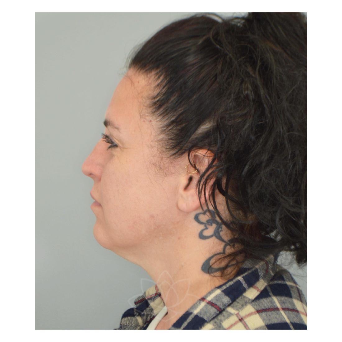 Jordan L. Wallin, MD facelift after — St. George, UT
