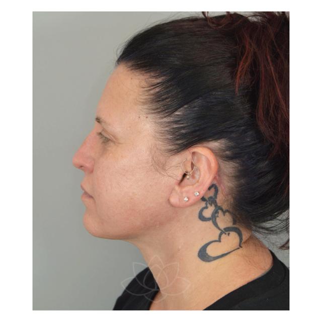 Facelift before at Jordan L. Wallin, MD in St. George, UT