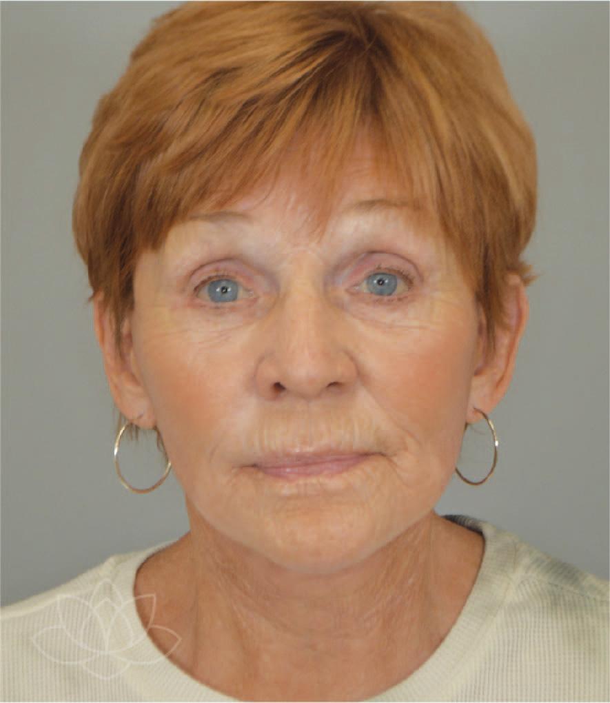 Jordan L. Wallin, MD facelift after — St. George, UT