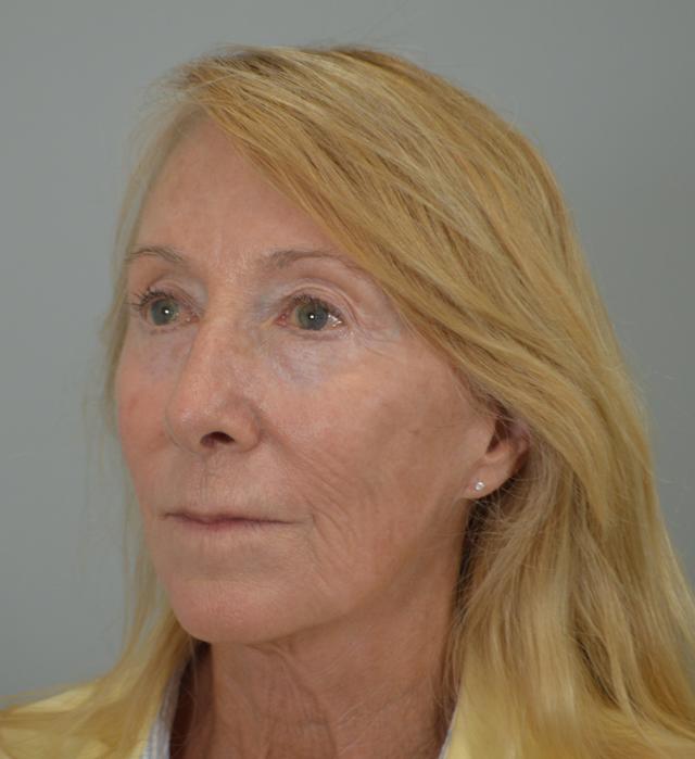 Facelift before at Jordan L. Wallin, MD in St. George, UT