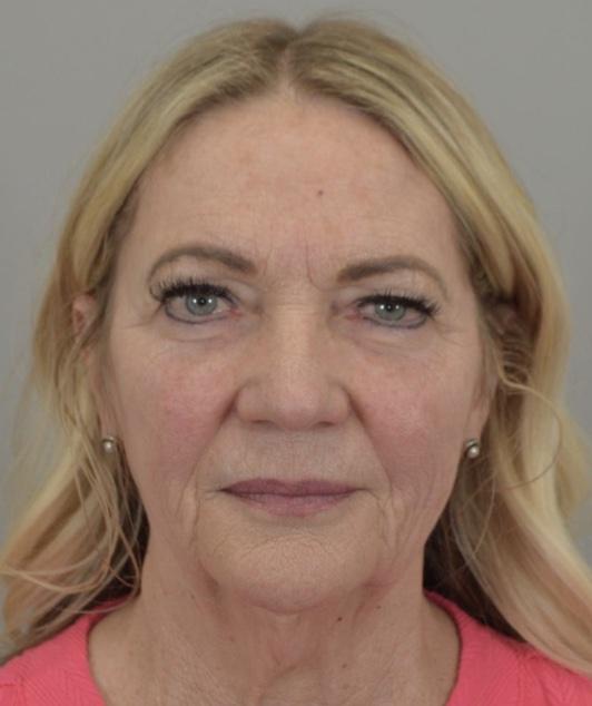 Neck Lift before at Jordan L. Wallin, MD in St. George, UT