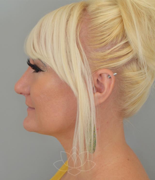 Functional Rhinoplasty after at Jordan L. Wallin, MD in St. George, UT