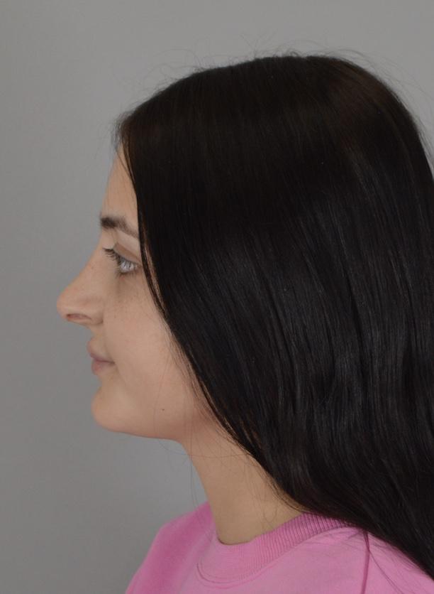 Rhinoplasty before at Jordan L. Wallin, MD in St. George, UT