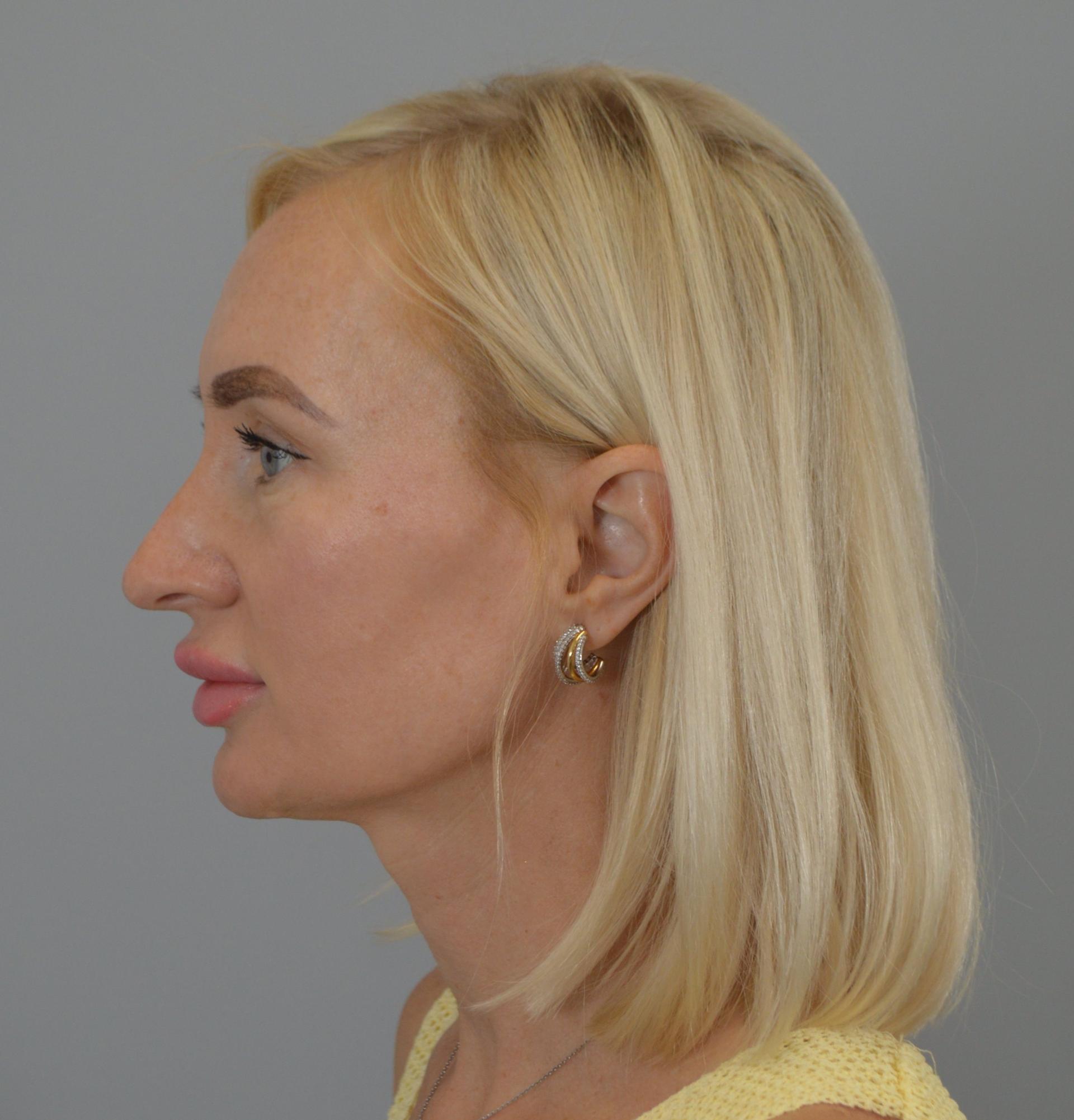 Jordan L. Wallin, MD rhinoplasty after — St. George, UT
