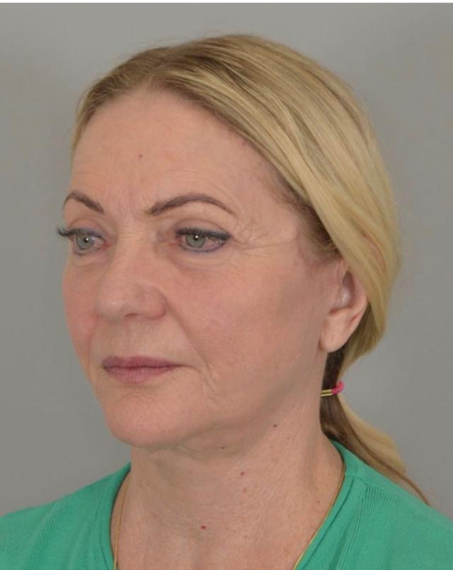Mini Facelift after at Jordan L. Wallin, MD in St. George, UT
