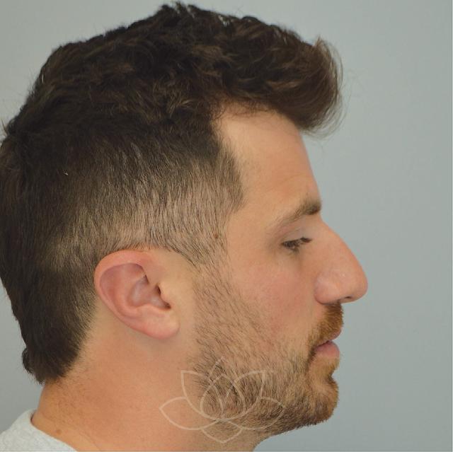 Functional Rhinoplasty before at Jordan L. Wallin, MD in St. George, UT