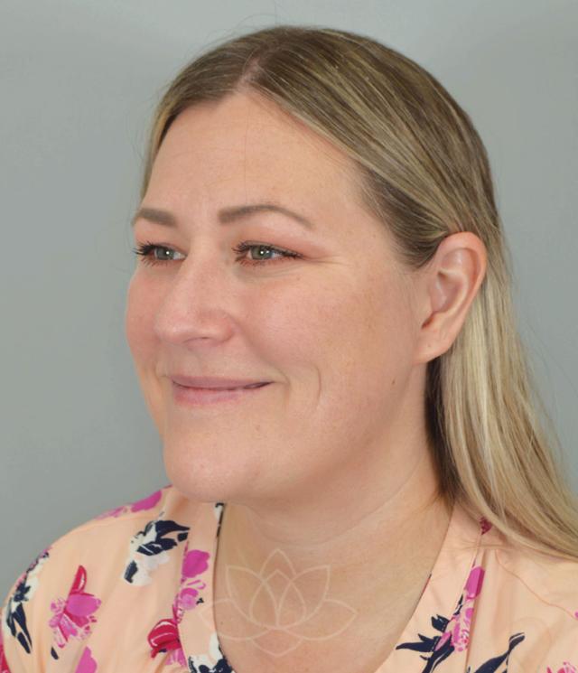 Facelift after at Jordan L. Wallin, MD in St. George, UT