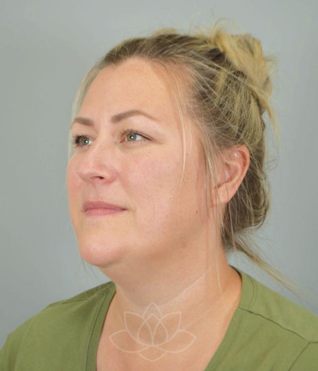 Facelift before at Jordan L. Wallin, MD in St. George, UT