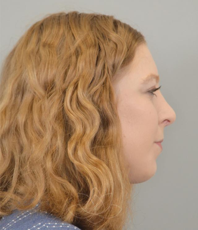 Functional Rhinoplasty after at Jordan L. Wallin, MD in St. George, UT
