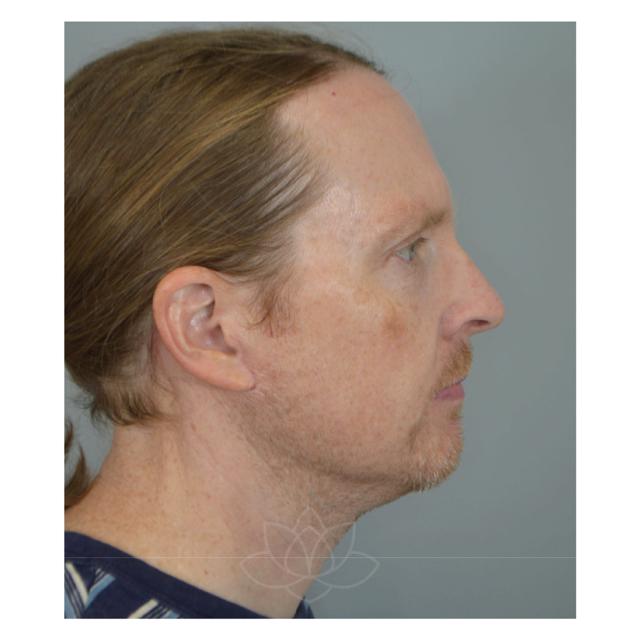 Facelift after at Jordan L. Wallin, MD in St. George, UT