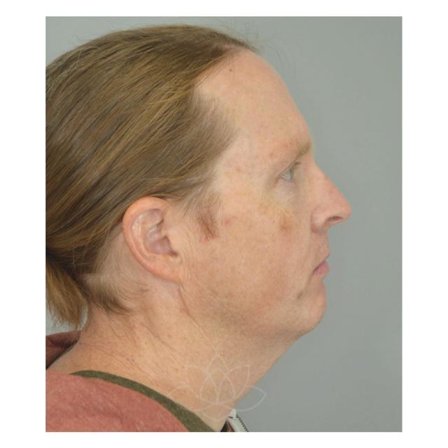 Facelift before at Jordan L. Wallin, MD in St. George, UT