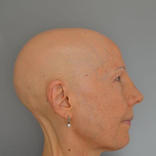 Functional Rhinoplasty after at Jordan L. Wallin, MD in St. George, UT