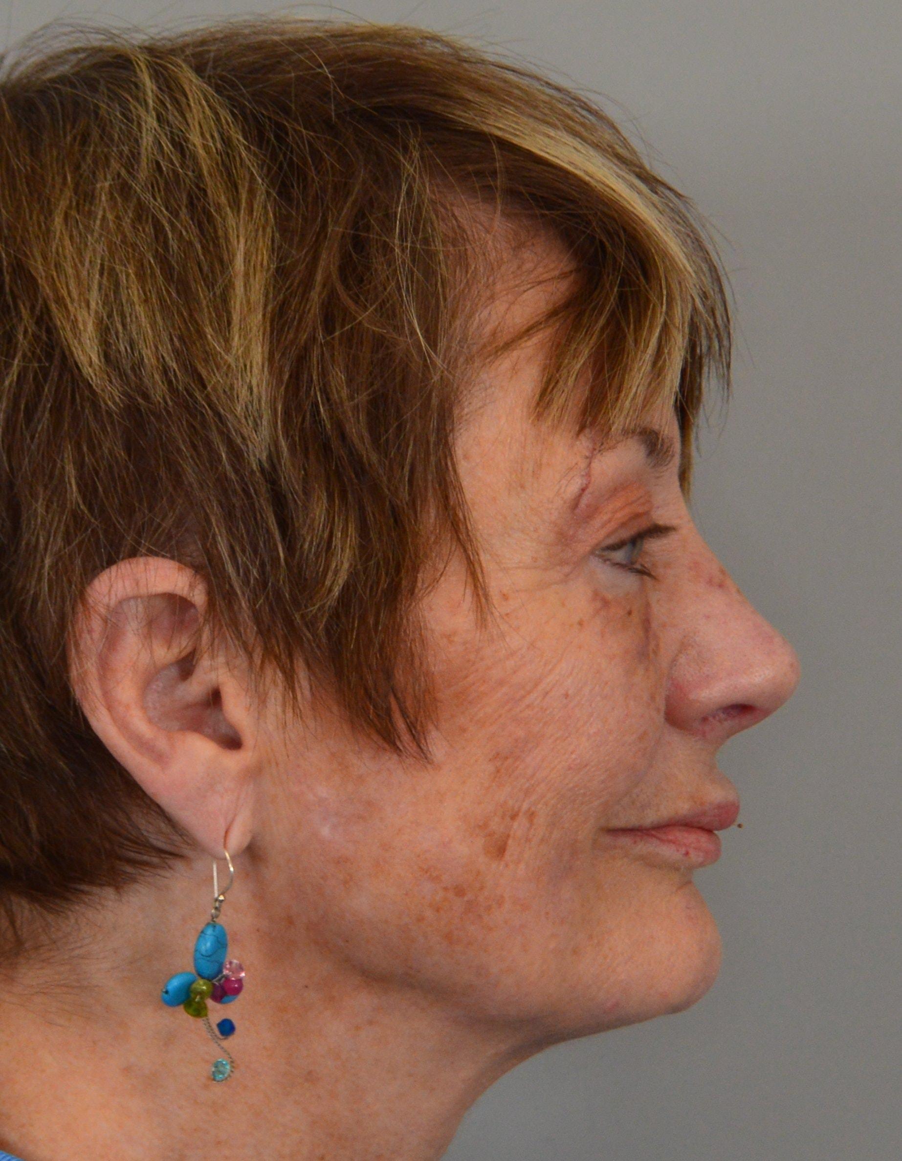 Jordan L. Wallin, MD rhinoplasty after — St. George, UT