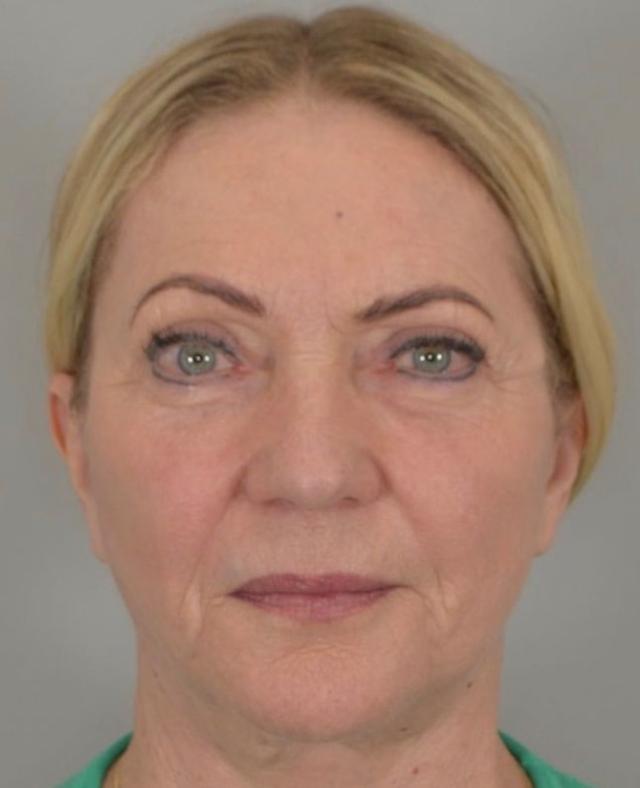 Blepharoplasty after at Jordan L. Wallin, MD in St. George, UT