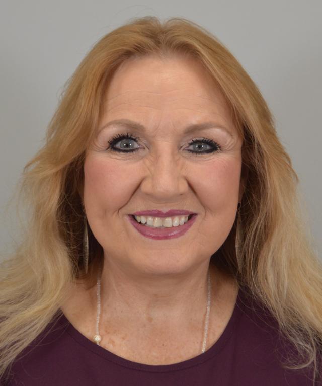 Facelift after at Jordan L. Wallin, MD in St. George, UT