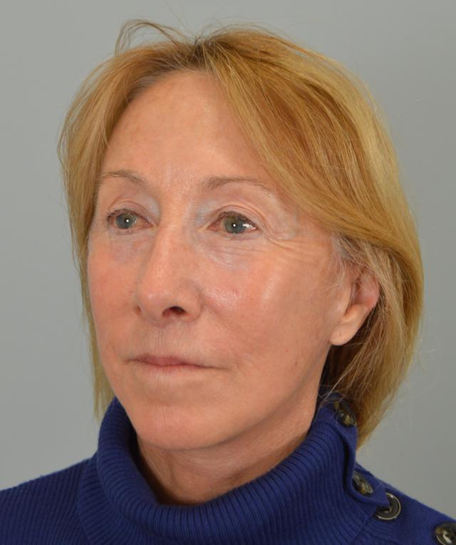 Facelift after at Jordan L. Wallin, MD in St. George, UT