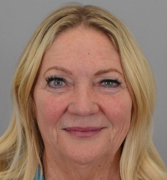 Blepharoplasty before at Jordan L. Wallin, MD in St. George, UT