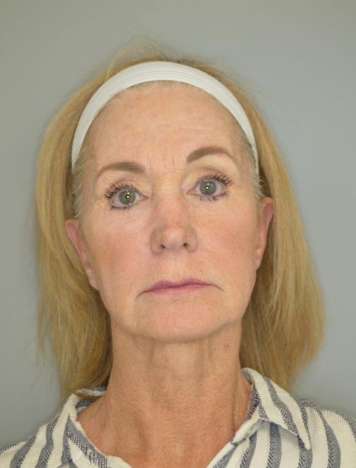 Facelift before at Jordan L. Wallin, MD in St. George, UT