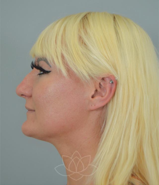 Functional Rhinoplasty before at Jordan L. Wallin, MD in St. George, UT