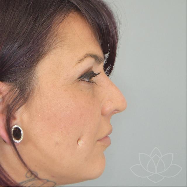 Functional Rhinoplasty before at Jordan L. Wallin, MD in St. George, UT