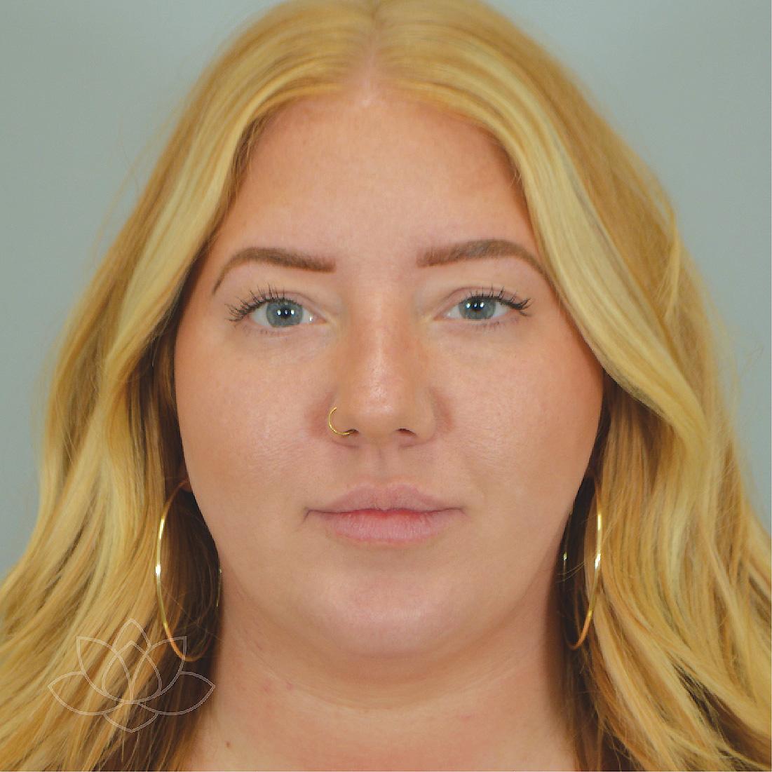 Jordan L. Wallin, MD facelift after — St. George, UT