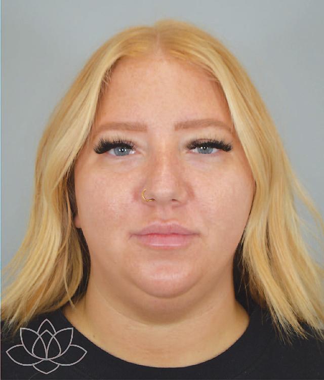 Facelift before at Jordan L. Wallin, MD in St. George, UT