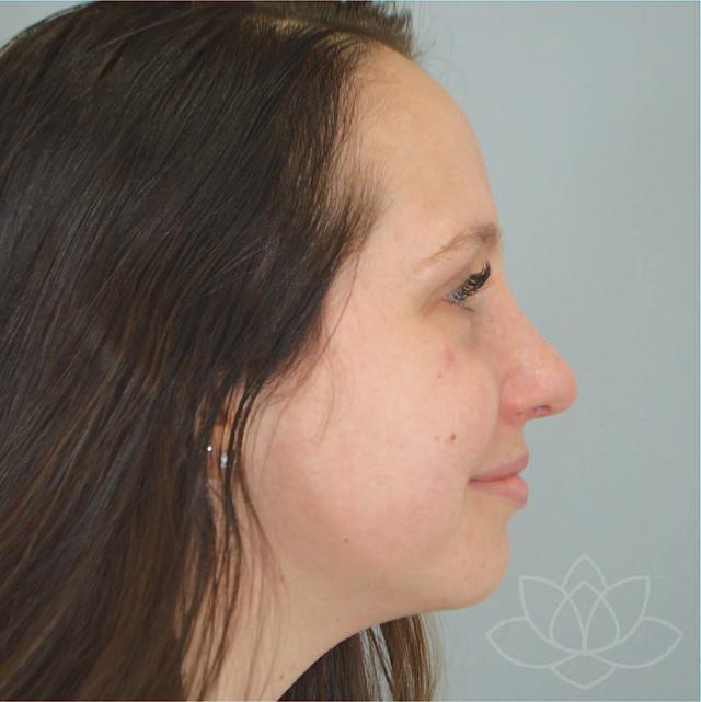 Functional Rhinoplasty after at Jordan L. Wallin, MD in St. George, UT