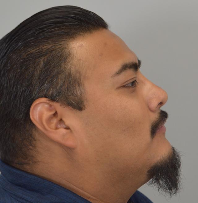Functional Rhinoplasty after at Jordan L. Wallin, MD in St. George, UT
