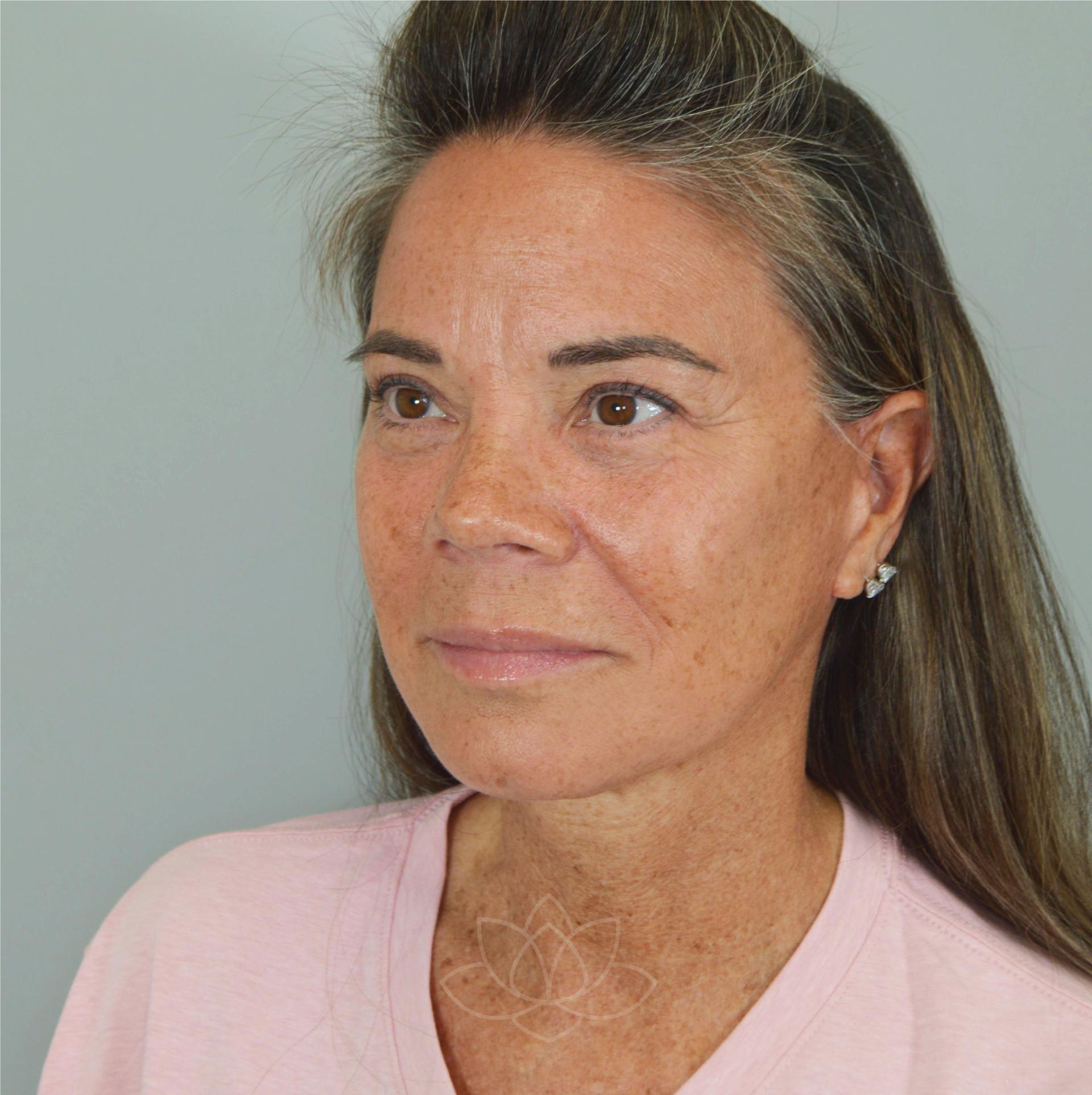 Jordan L. Wallin, MD facelift after — St. George, UT