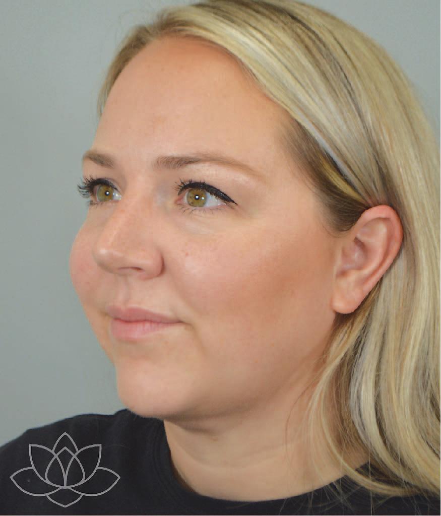Jordan L. Wallin, MD facelift after — St. George, UT