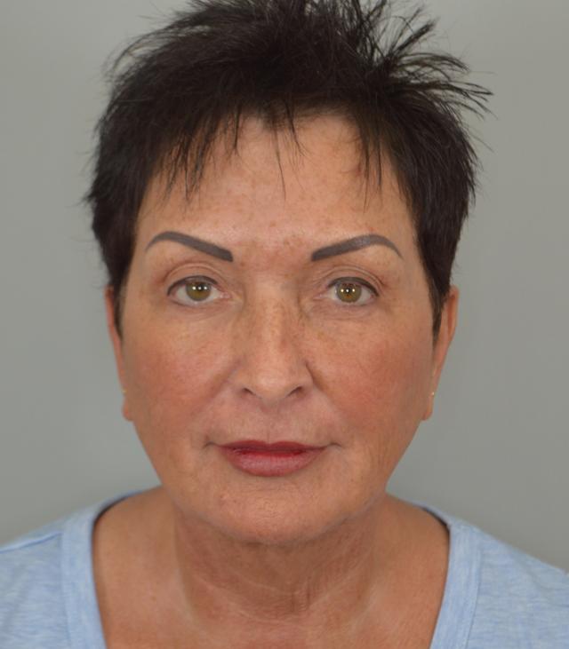 Facelift before at Jordan L. Wallin, MD in St. George, UT