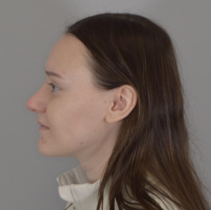 Jordan L. Wallin, MD rhinoplasty after — St. George, UT