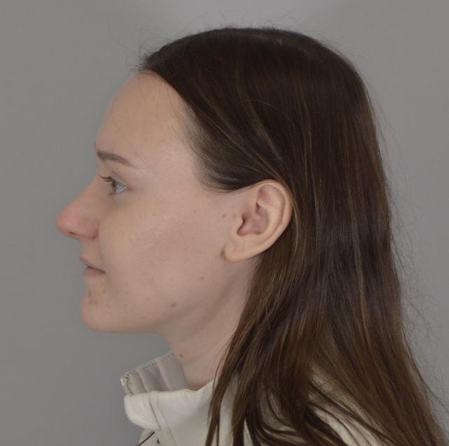 Functional Rhinoplasty after at Jordan L. Wallin, MD in St. George, UT