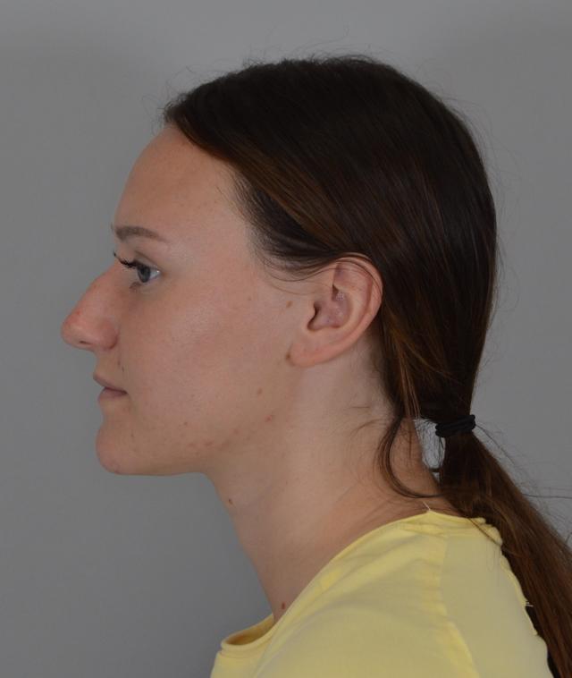 Functional Rhinoplasty before at Jordan L. Wallin, MD in St. George, UT