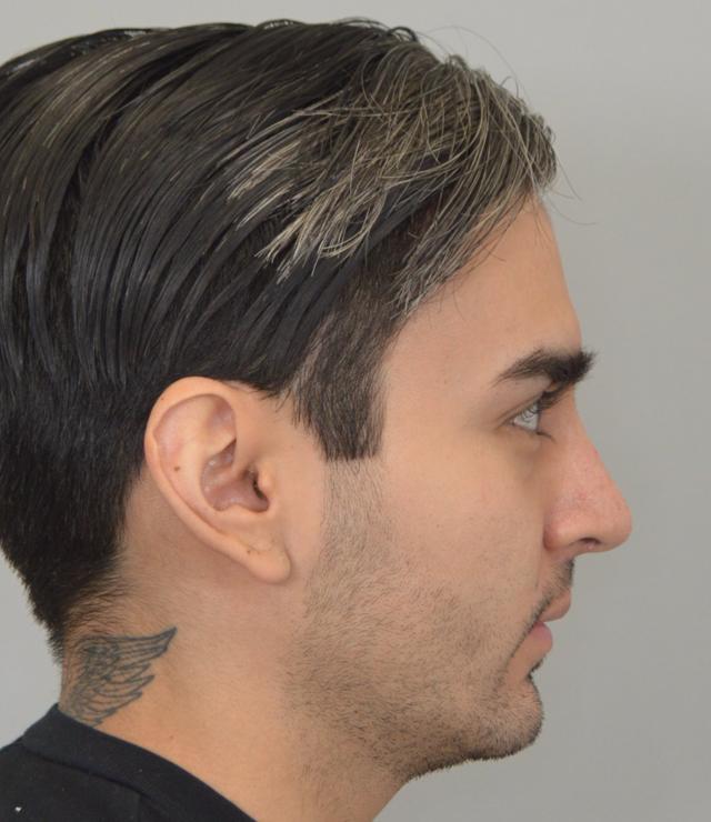 Functional Rhinoplasty after at Jordan L. Wallin, MD in St. George, UT
