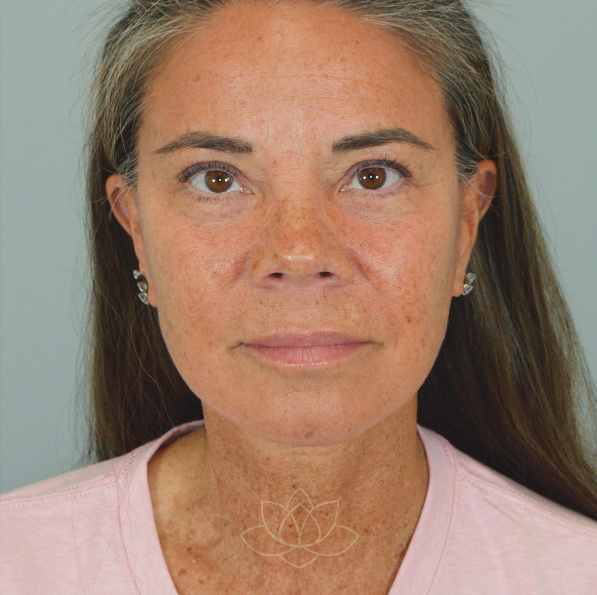 Jordan L. Wallin, MD facelift after — St. George, UT