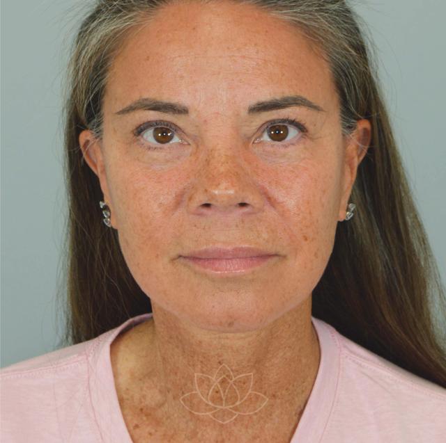 Facelift after at Jordan L. Wallin, MD in St. George, UT