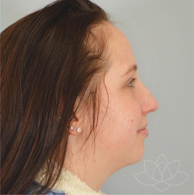 Functional Rhinoplasty before at Jordan L. Wallin, MD in St. George, UT