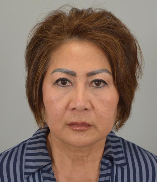 Blepharoplasty before at Jordan L. Wallin, MD in St. George, UT