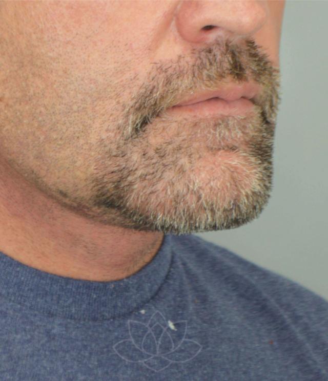 Chin Implant after at Jordan L. Wallin, MD in St. George, UT