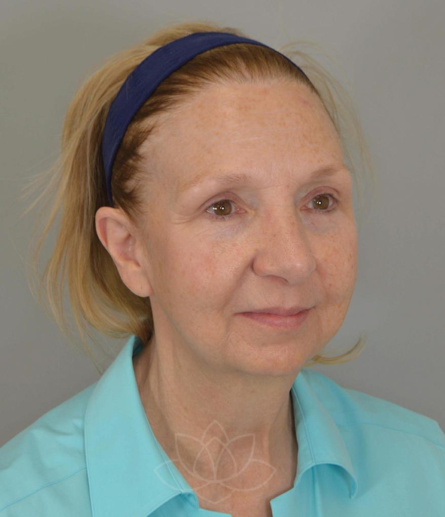 Jordan L. Wallin, MD facelift after — St. George, UT