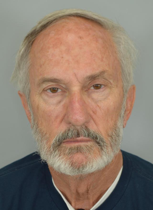 Facelift before at Jordan L. Wallin, MD in St. George, UT