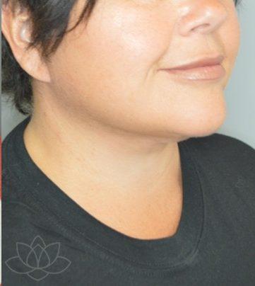 Facelift before at Jordan L. Wallin, MD in St. George, UT
