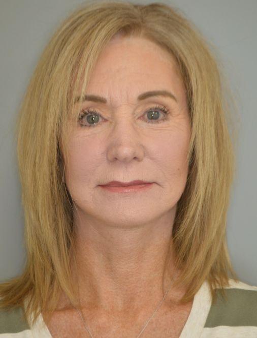 Facelift after at Jordan L. Wallin, MD in St. George, UT